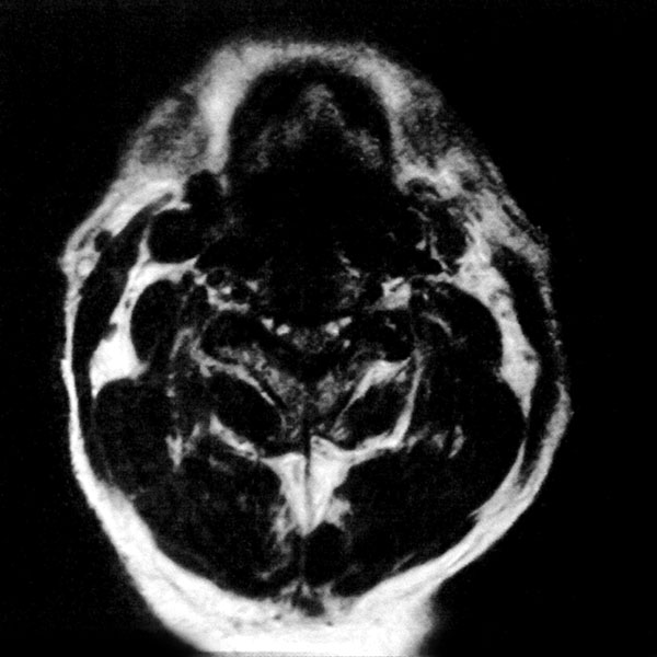 以前の当院のMRI画像 撮像時間3分16秒