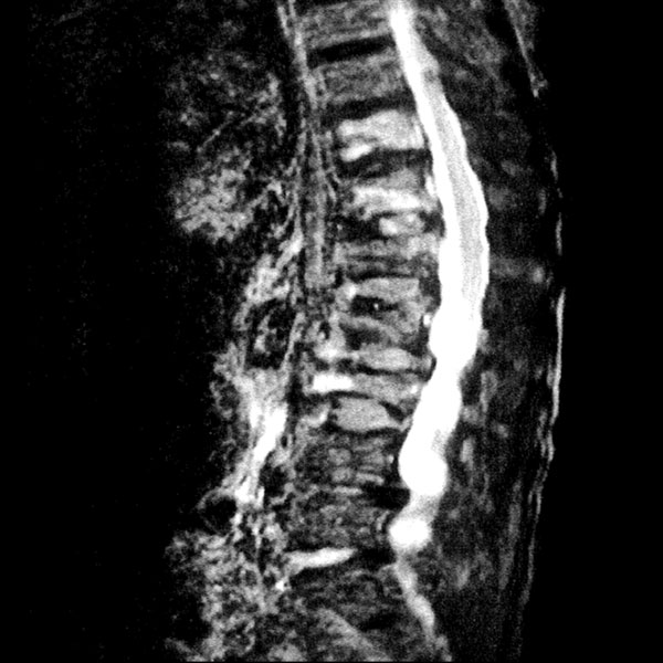 以前の当院のMRI画像 モーションアーチファクト＋ 撮像時間3分26秒